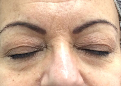 womens-mesotherapy-before2