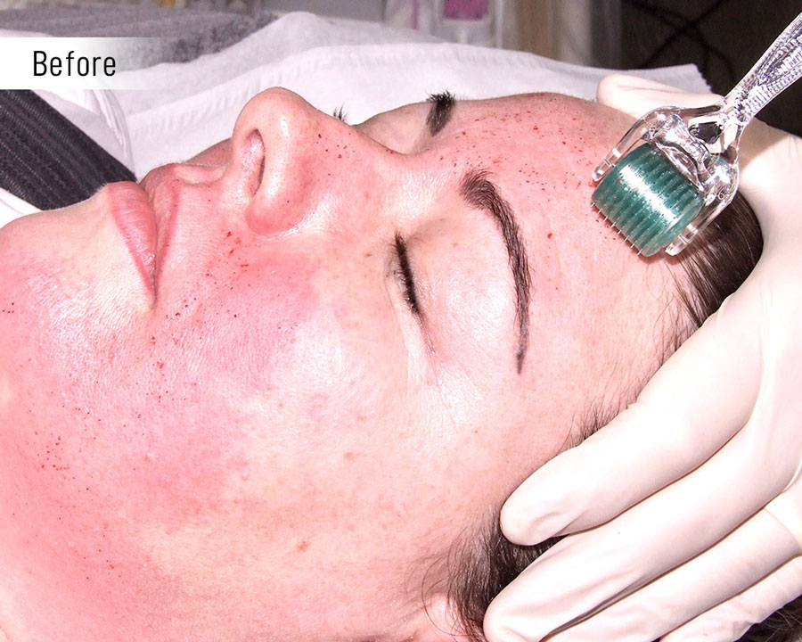 Microneedling-before Smudge-free.co.uk